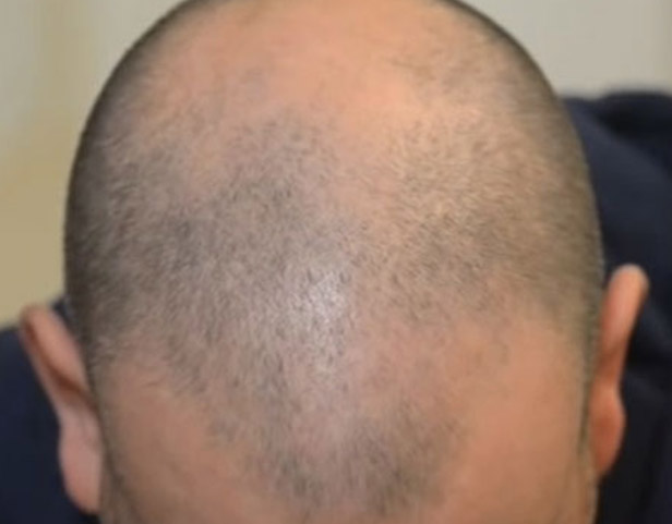 after_scalp_head_iranscalp_03